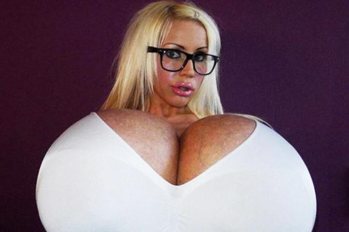 Esta mujer tiene implantes de 20 kilos
