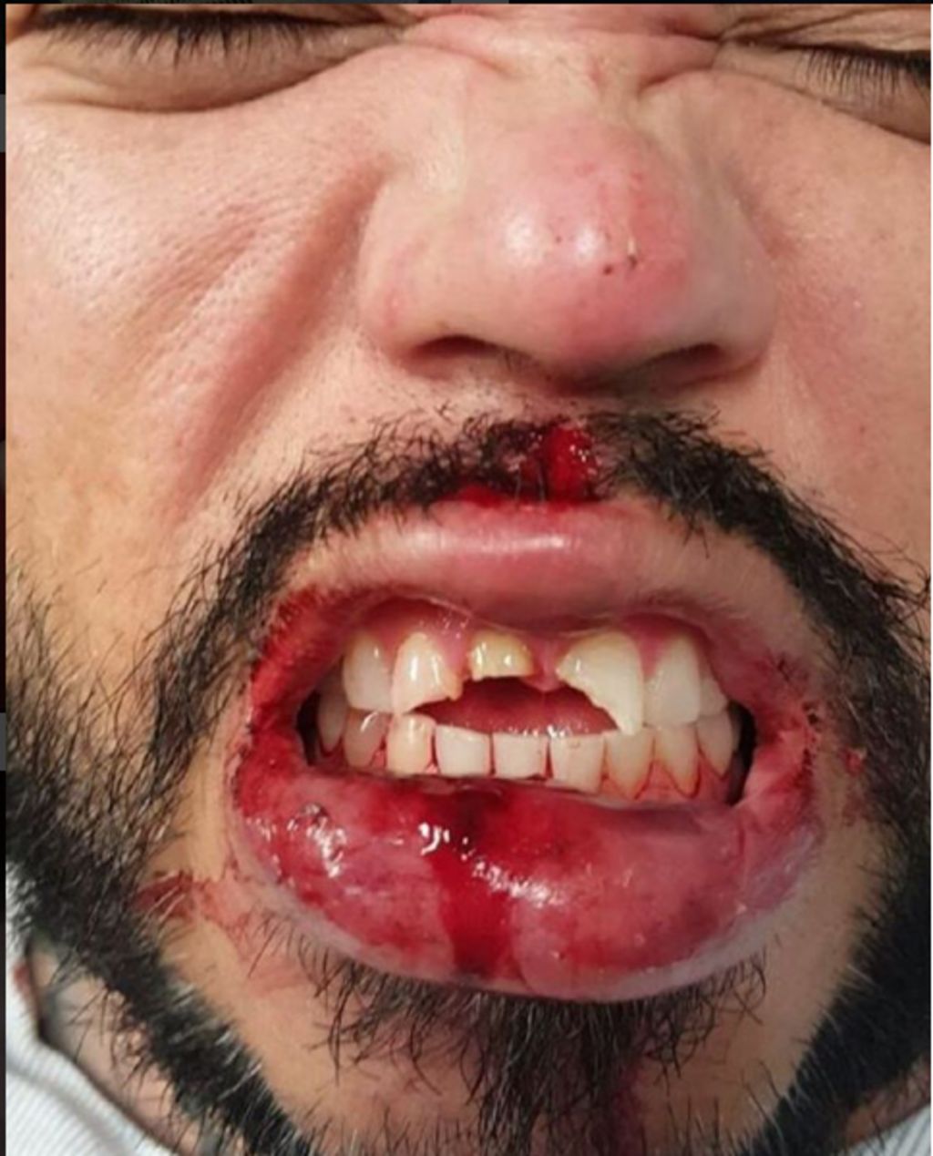 A.B. Quintanilla rompe sus dientes tras 20 'shots' de tequila