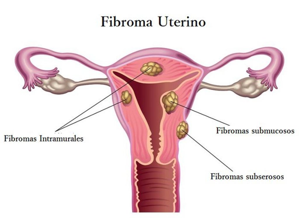 La presencia silenciosa de los fibromas uterinos