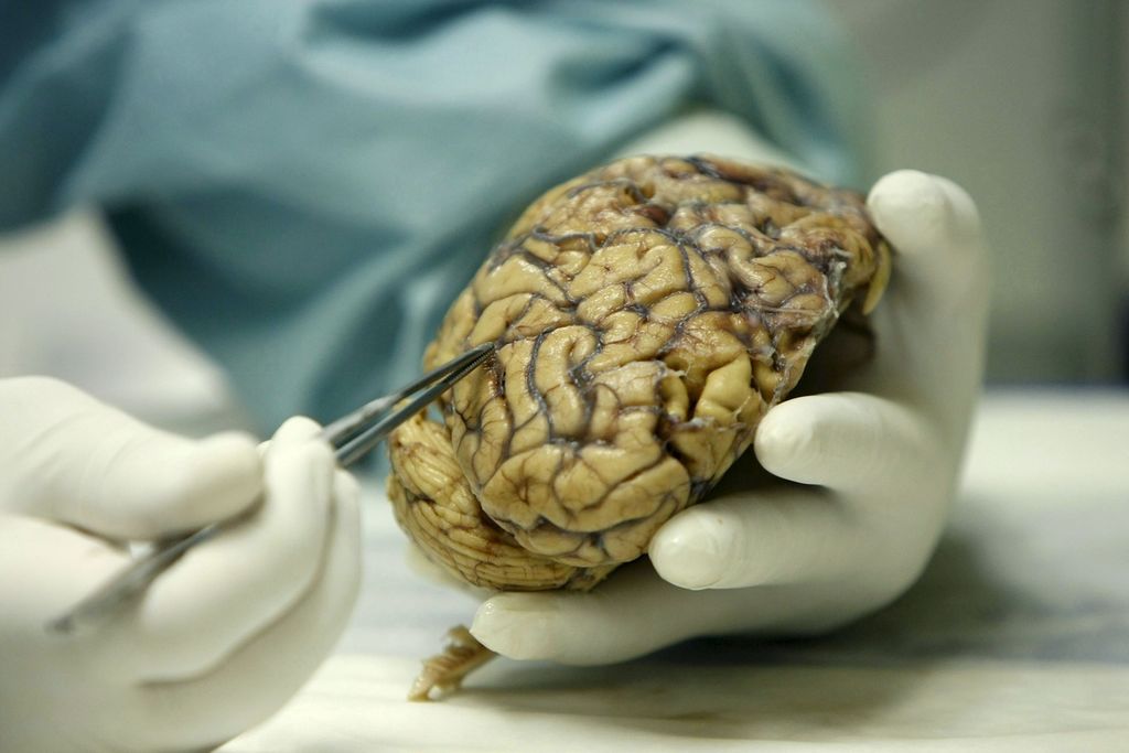 Bloqueo de la inflamación cerebral frena el Alzheimer
