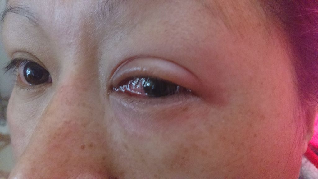 El zika provoca inflamación dentro de los ojos