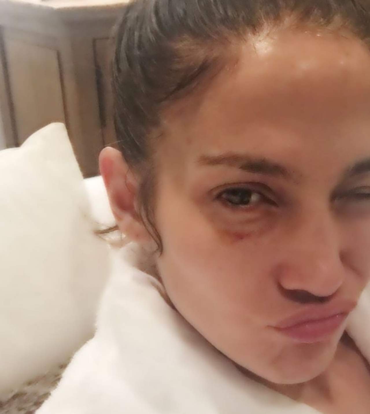 Publica Jennifer Lopez foto donde aparece con el ojo morado