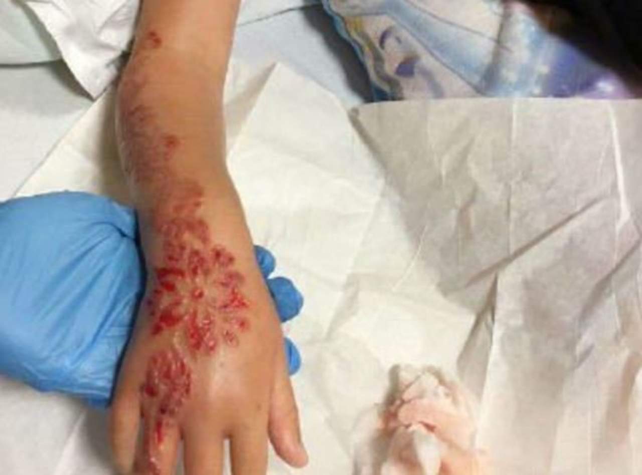 Causa tatuaje de henna graves quemaduras a niña