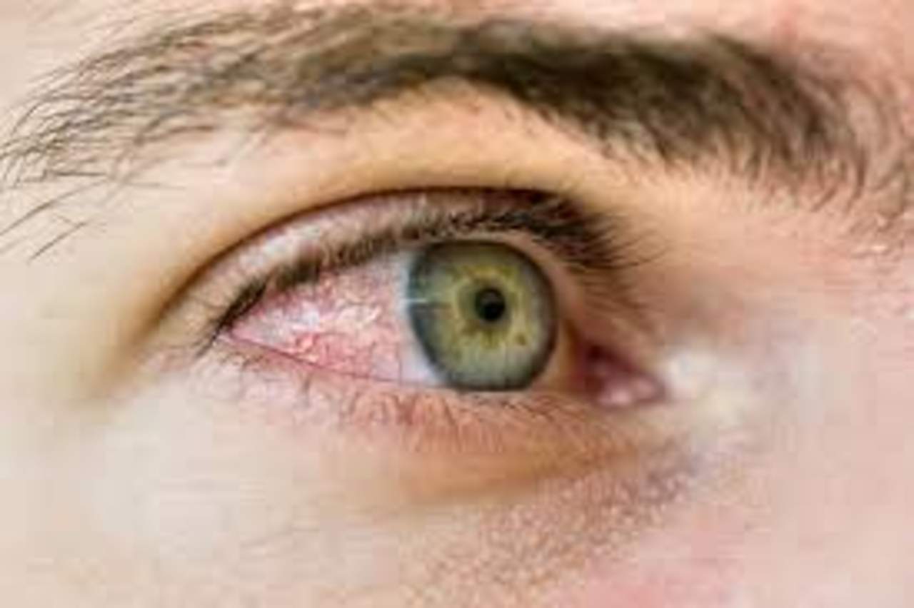 Aumenta síndrome de ojo seco por uso de pantallas y aire acondicionado