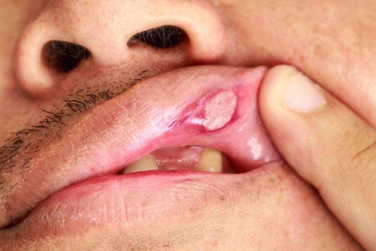 Herpes labial puede contagiarse a genitales