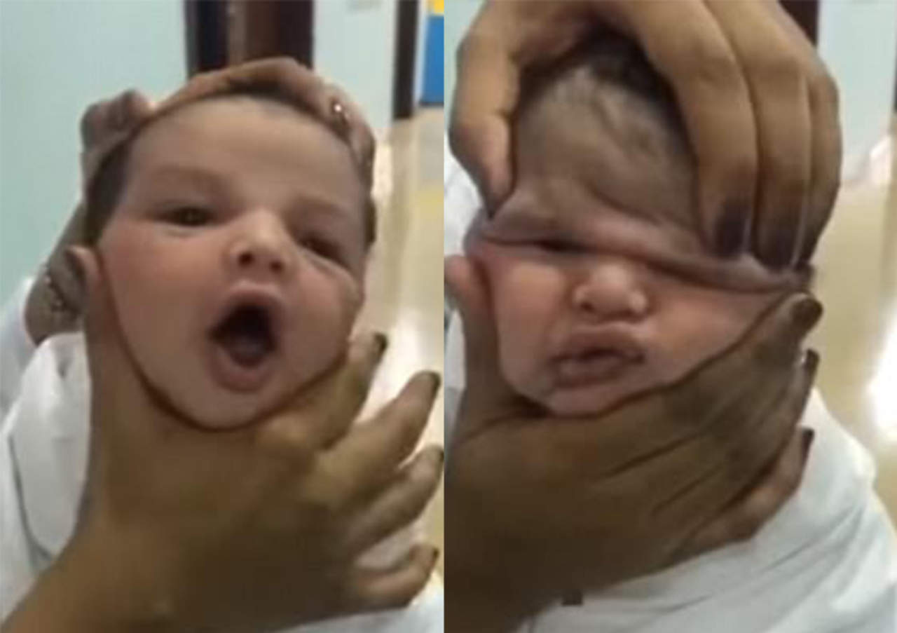 Despiden a enfermeras por 'aplastar' cara de bebé