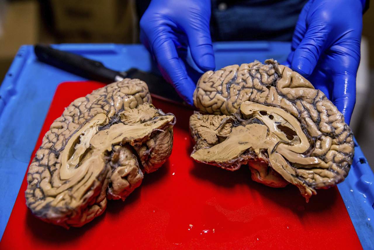 Hospital español crea banco de cerebros para el estudio de enfermedades