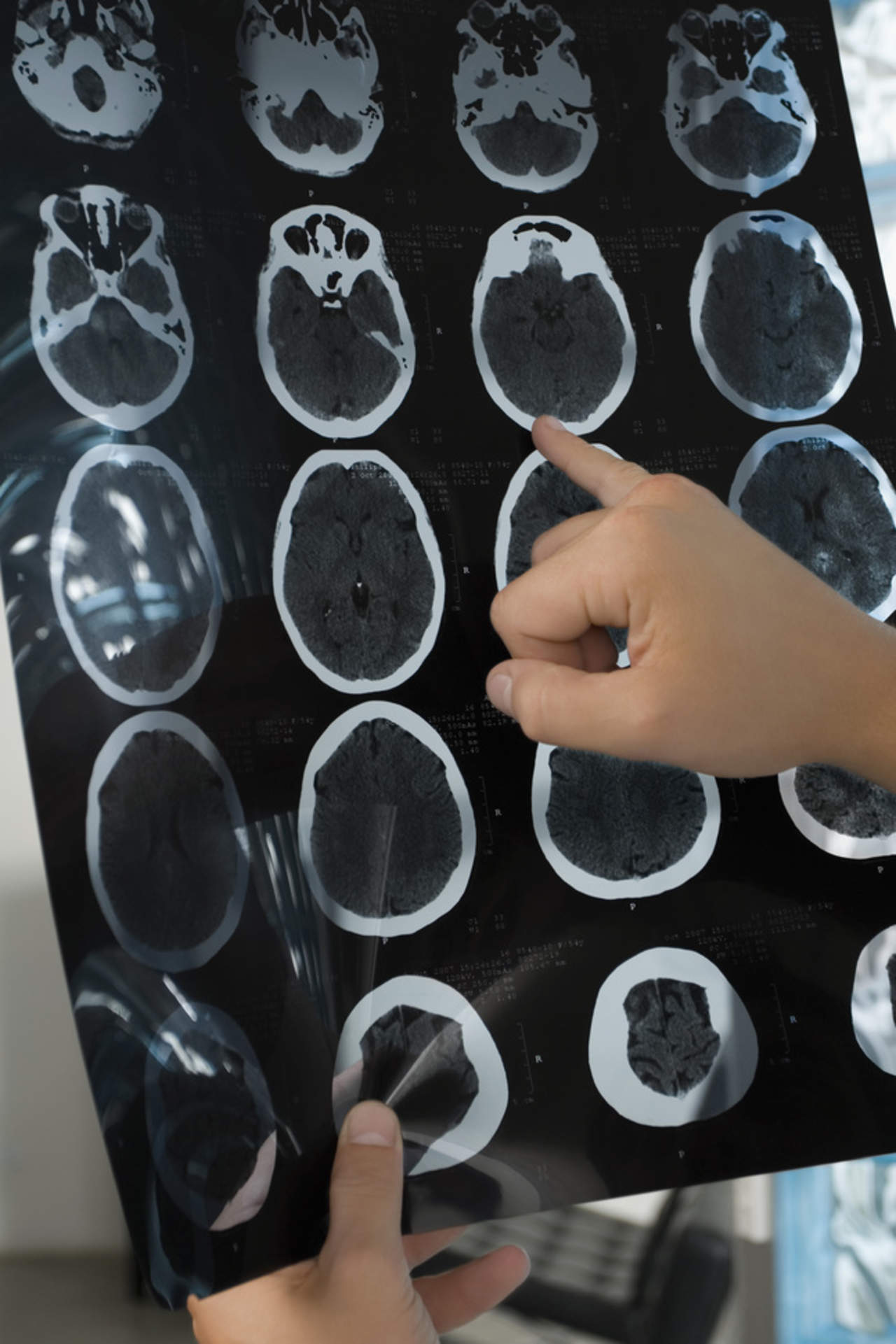 Hallan alteraciones cerebrales en personas sanas propensas al Alzheimer