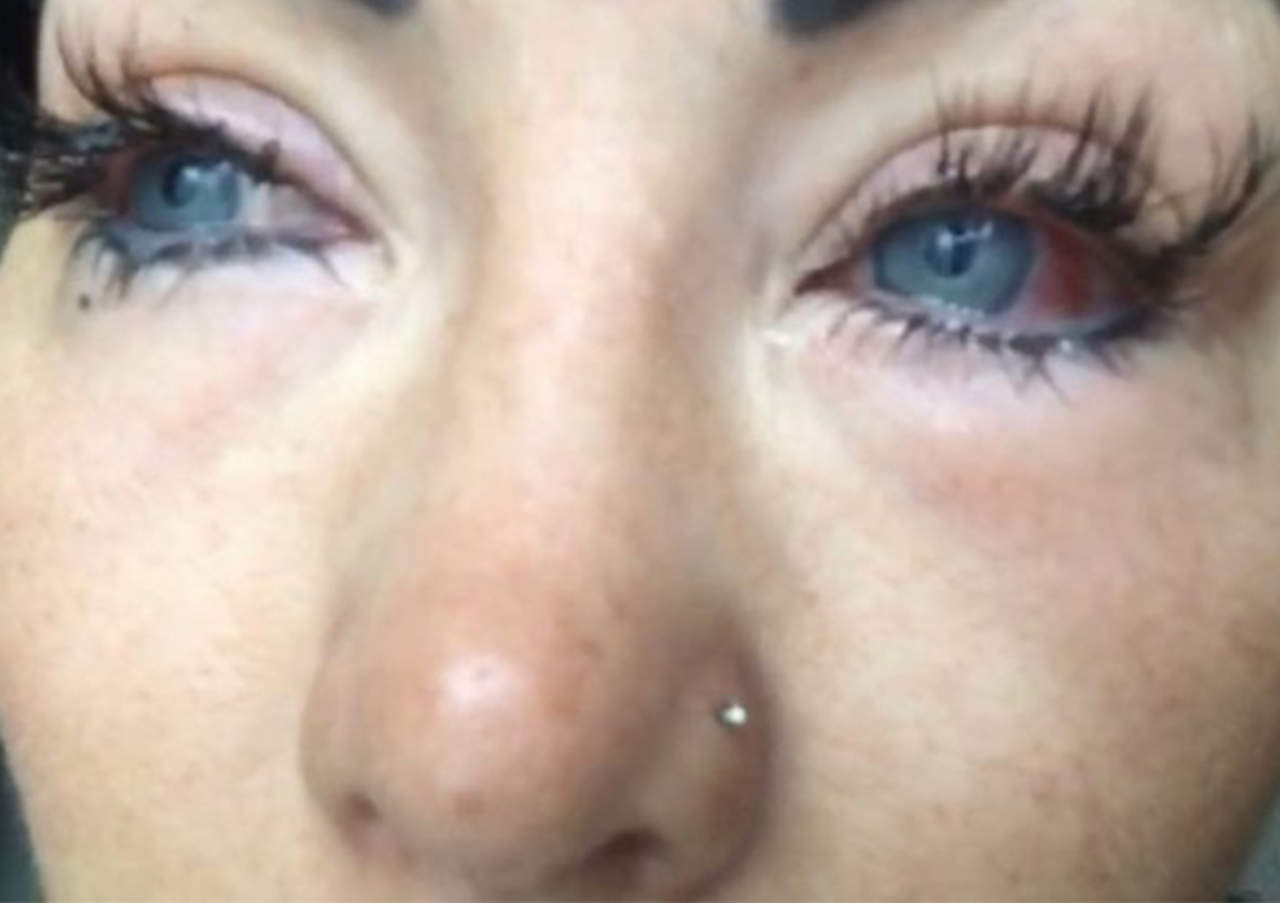 Instagramer con ceguera tras cirugía de cambio de color de ojos