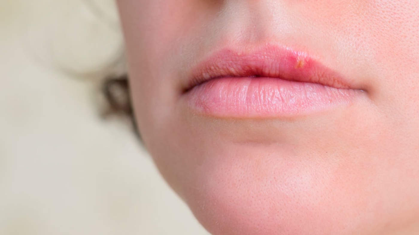 Infecciones respiratorias pueden causar fuegos labiales