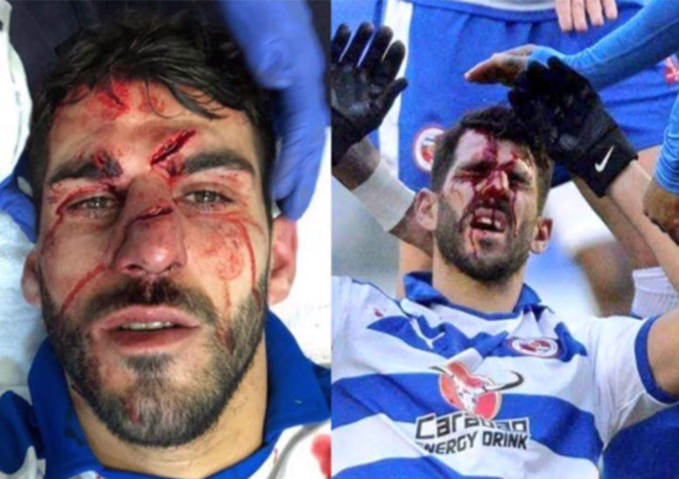 Jugador sufre fuerte pisotón en el rostro durante partido