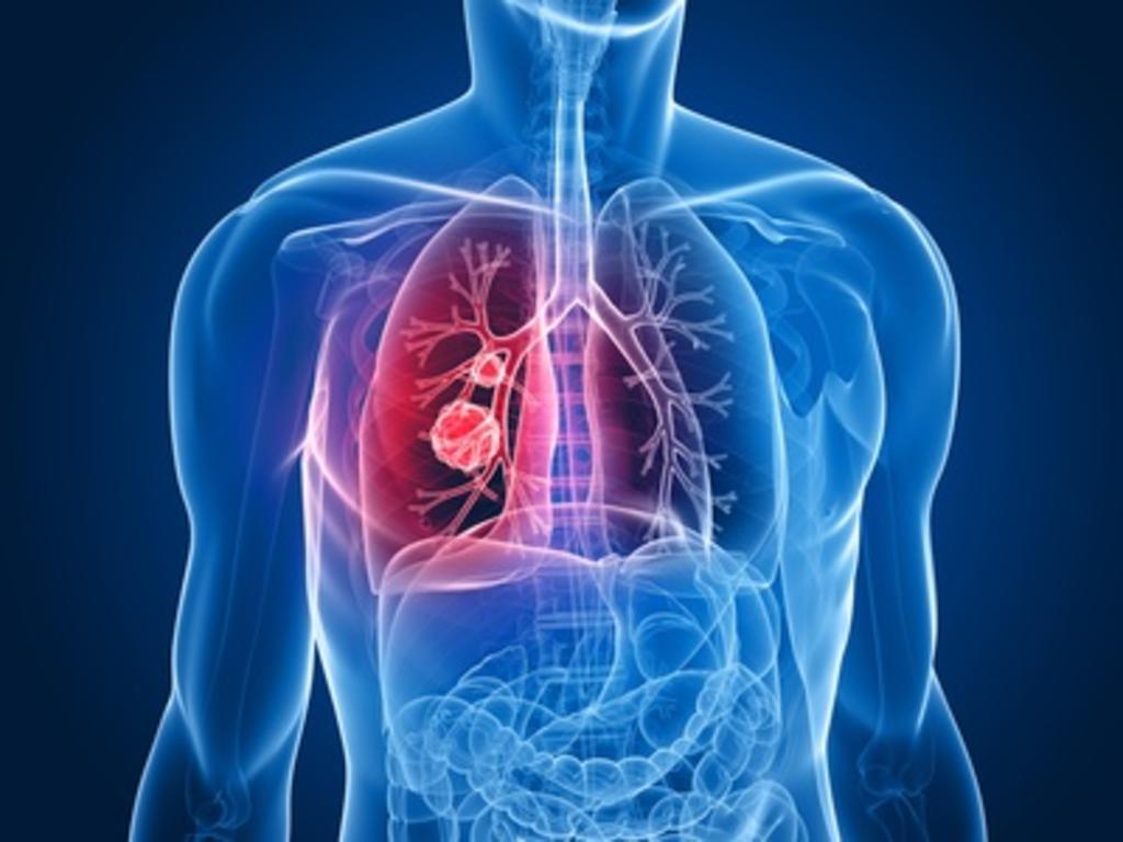 Cáncer de pulmón, con diagnóstico tardío en México
