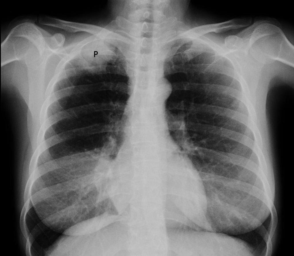 Cáncer de pulmón, detectado muy tarde en el 99% de los casos