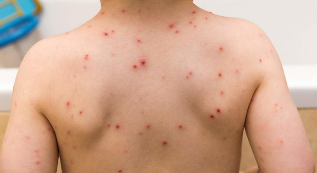 Incrementa 20 % casos de varicela en Coahuila