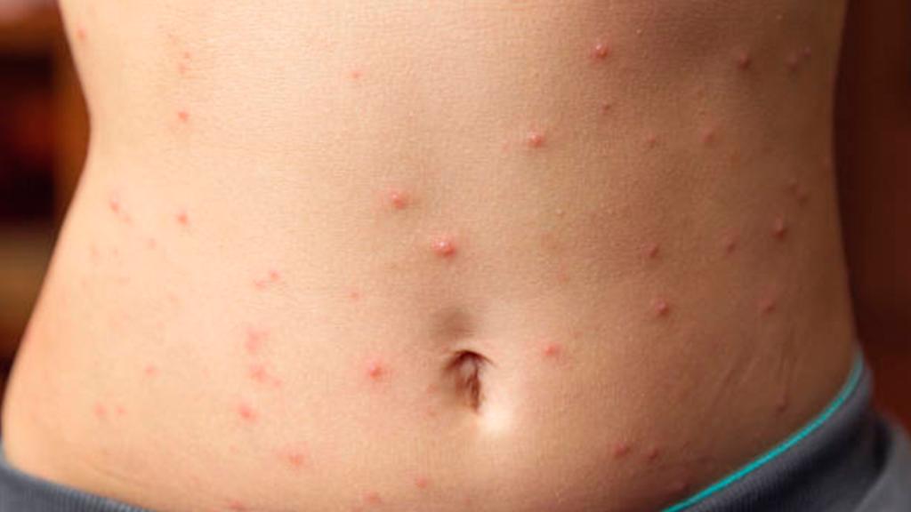 Aumentan casos de varicela en Coahuila