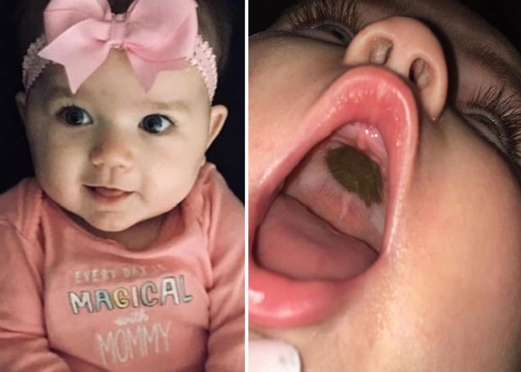 Madre preocupada por marca en la boca de su hija se lleva una sorpresa
