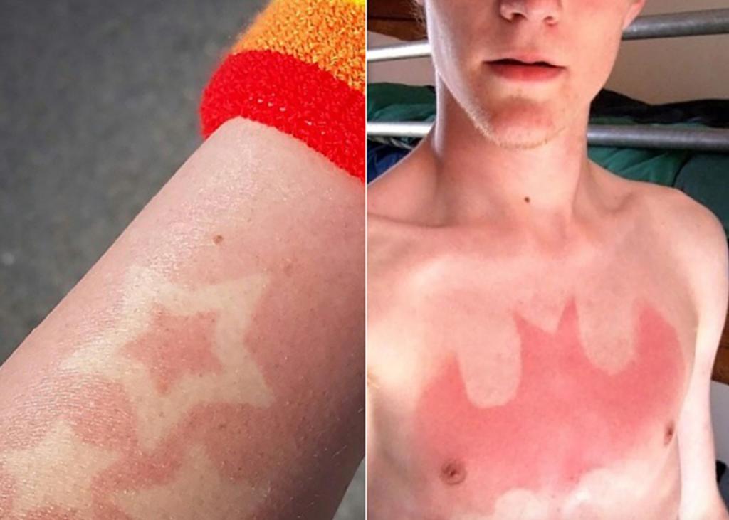 Tatuajes de ‘quemadura de sol’ son tendencia de moda