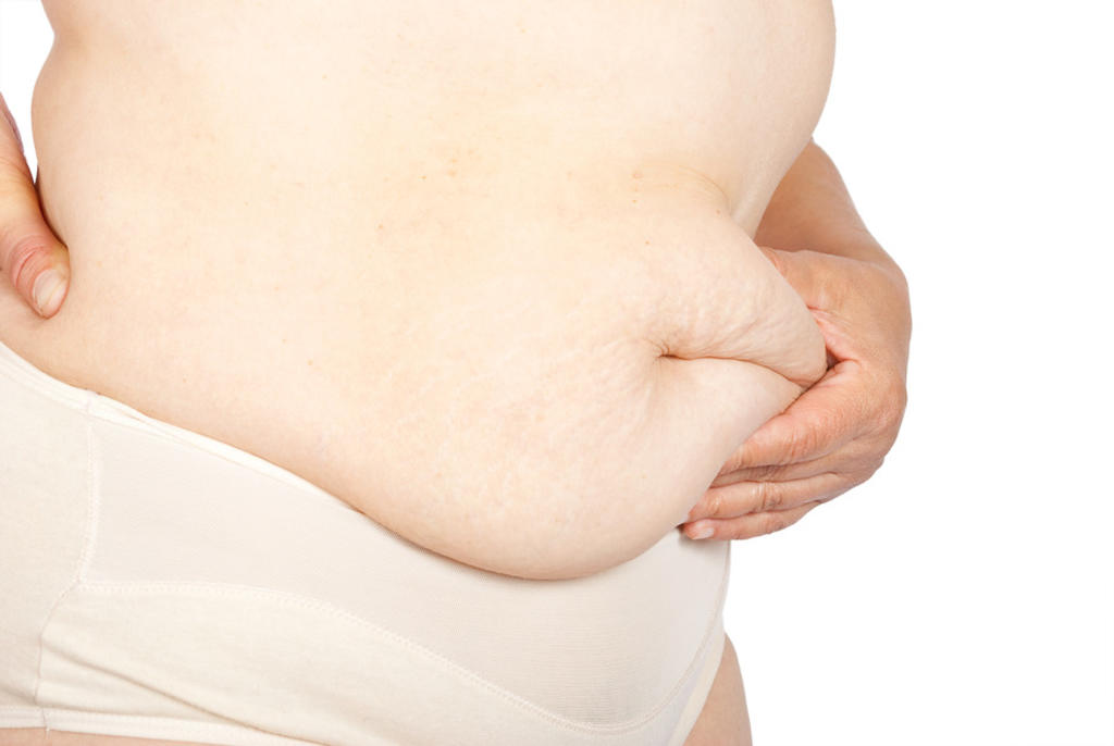 Reganancia de peso, un obstáculo en lucha contra la obesidad