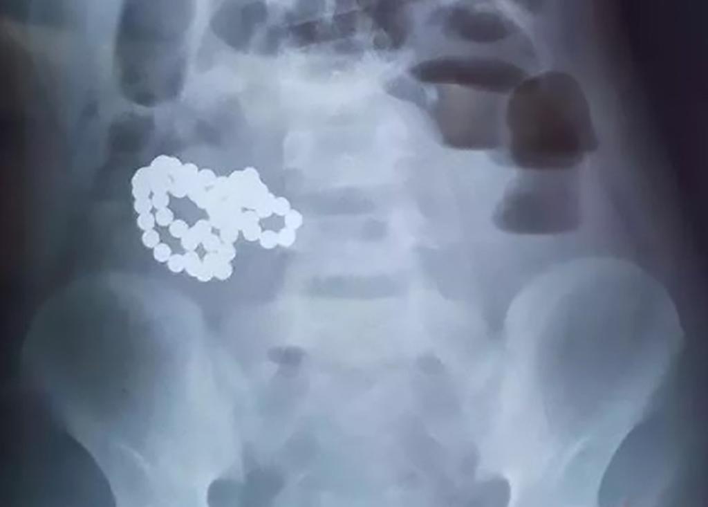 Extraen 61 bolas magnéticas del intestino de un niño