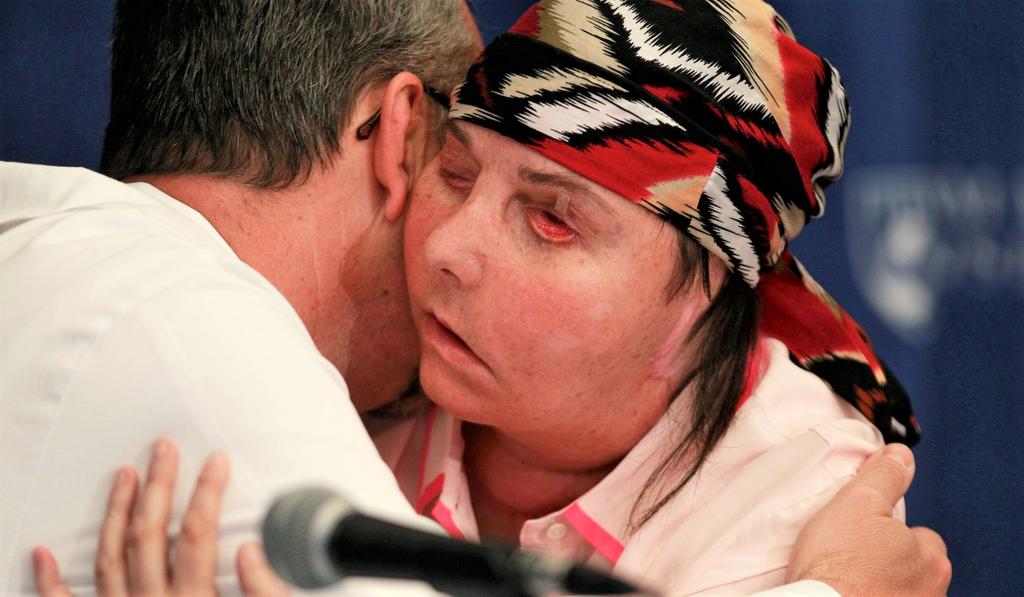 Mujer espera segundo trasplante facial tras daño tisular