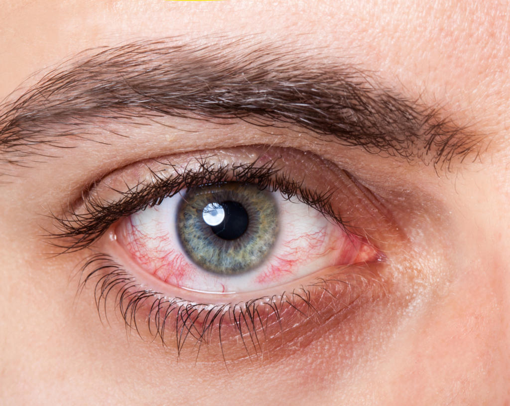 ¿Qué provoca los ojos rojos en las personas?