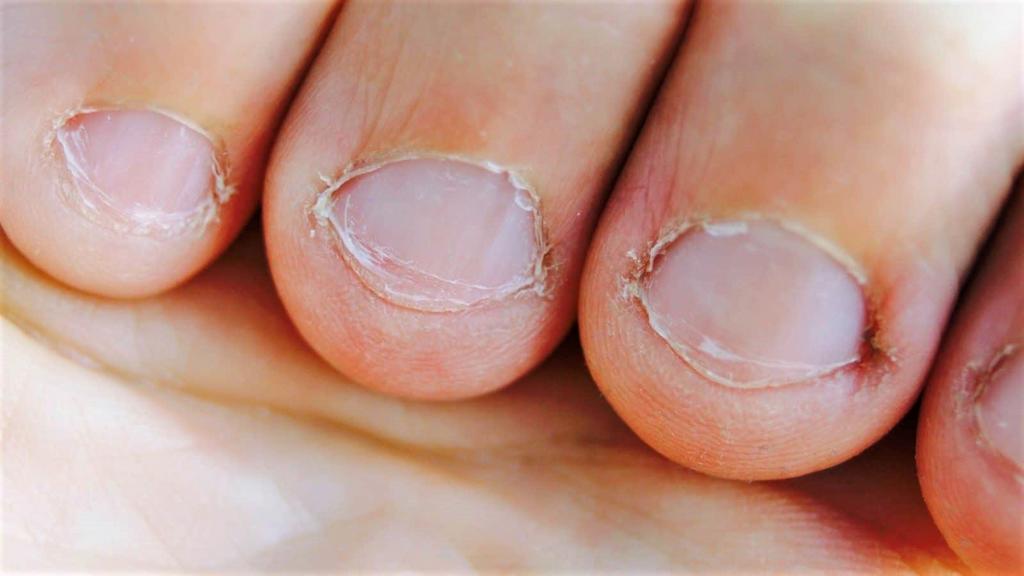 Morderse las uñas provoca deformación de los dedos e infecciones graves