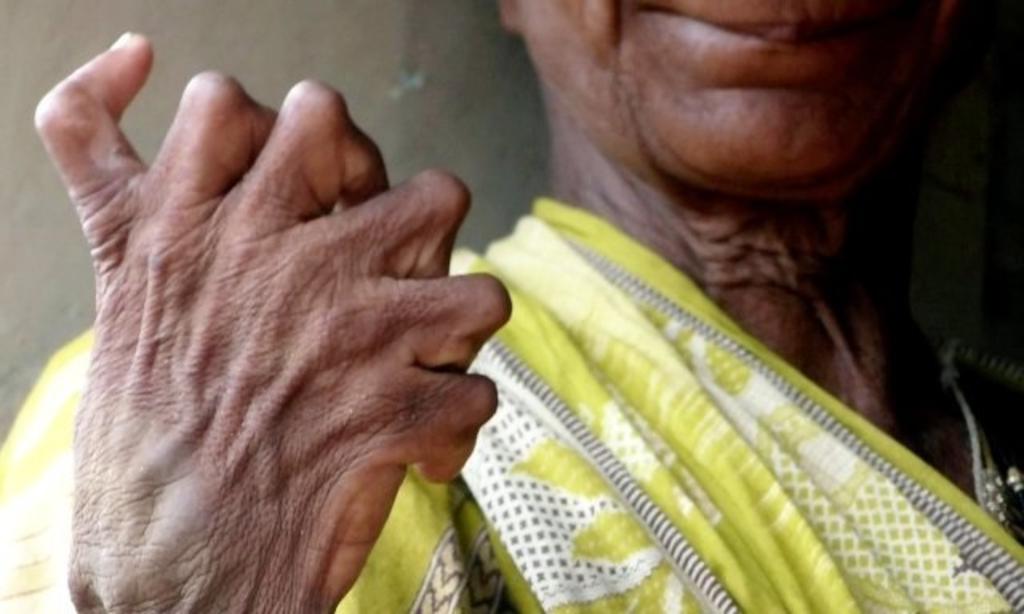 Kumar Nayak, la mujer que nació con 12 dedos en las manos y 20 en los pies