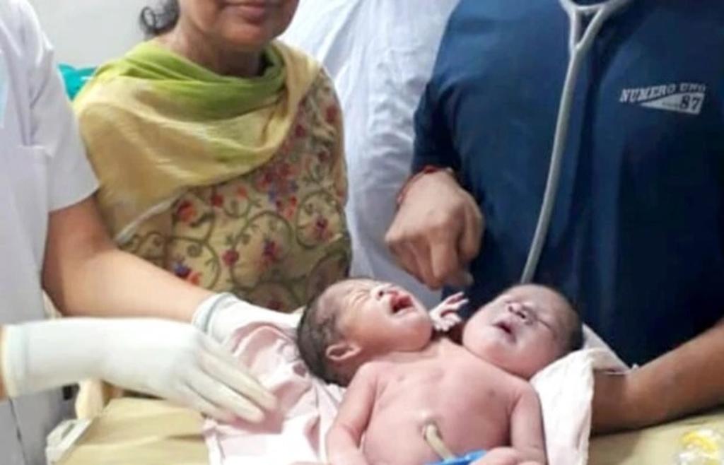 Mujer da a luz a bebé con dos cabezas y tres brazos