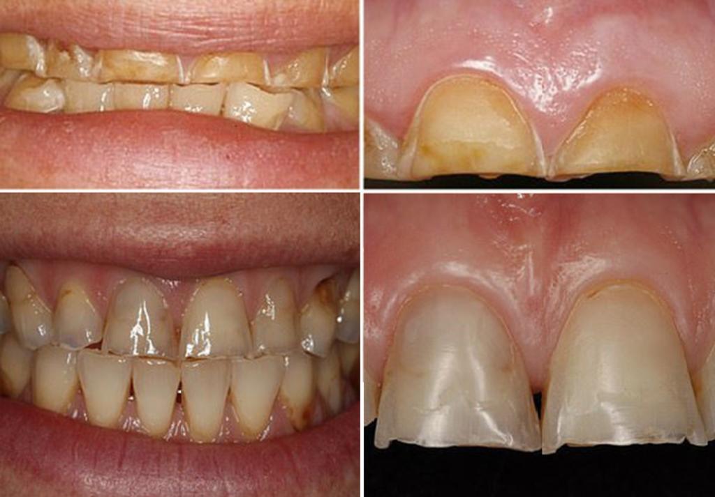Dentista muestra cómo el alcohol destruye los dientes
