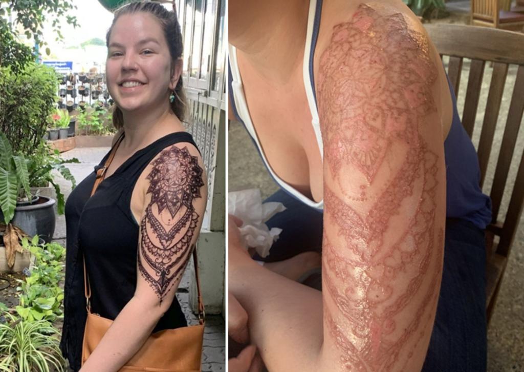 Tatuaje de henna le deja una enorme cicatriz