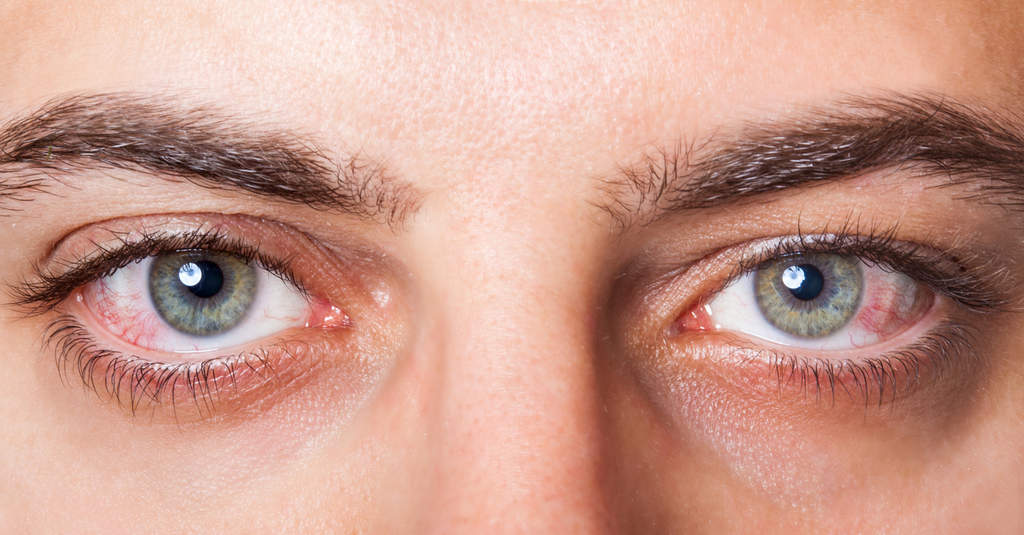 ¿Qué es la enfermedad ocular llamada glaucoma?