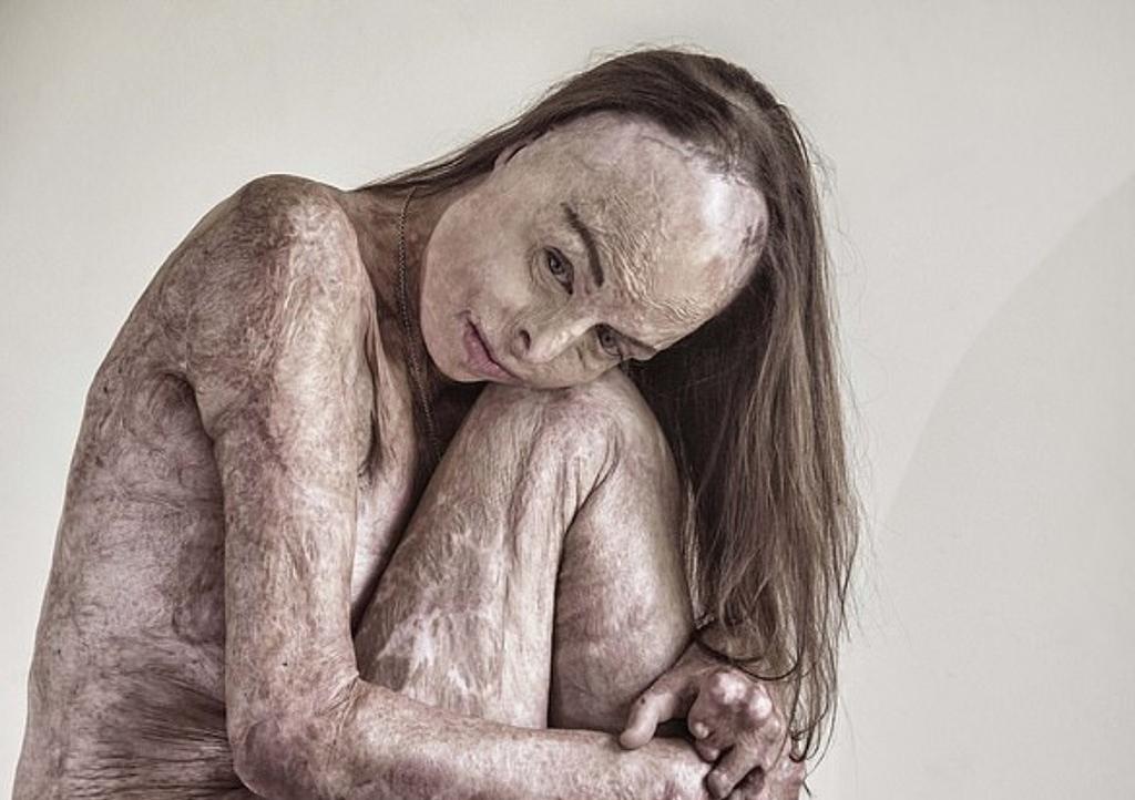 Sufrió quemaduras en el 85% del cuerpo; posa desnuda para mostar el 'arte' de su piel