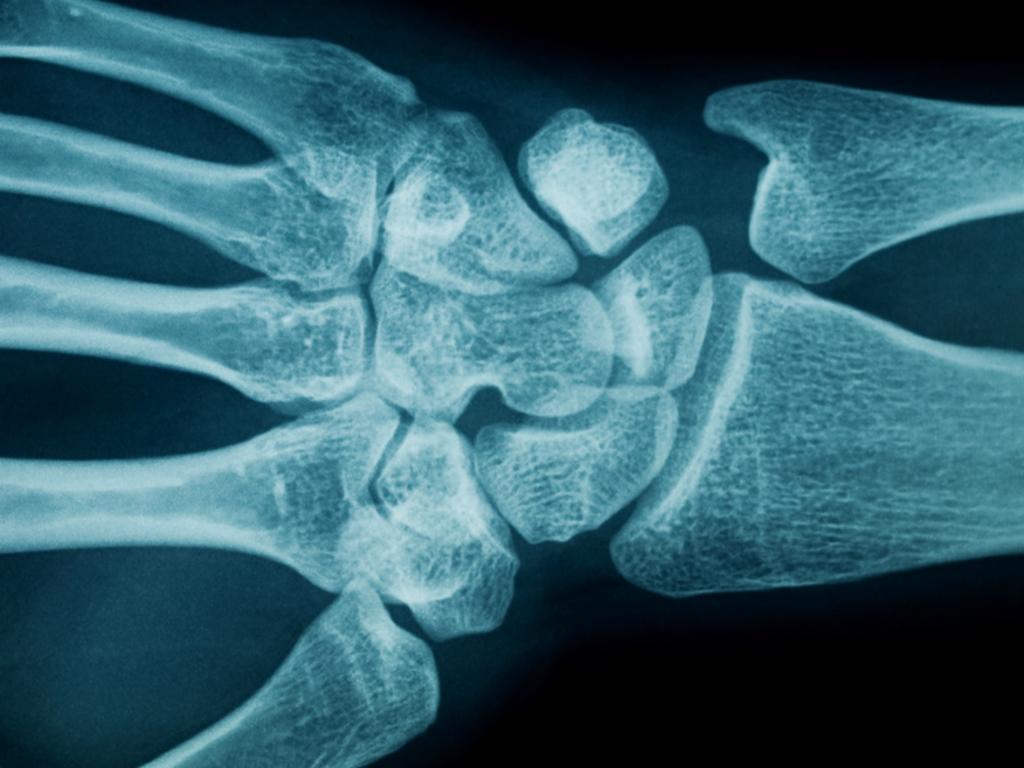¿Qué deben considerar los conductores con osteoporosis?