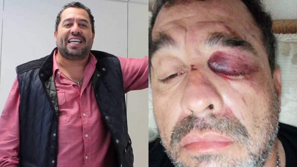 'Borrego' Nava muestra sus golpes tras accidente en moto