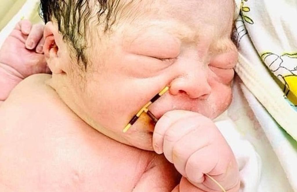 Bebé nace sosteniendo el anticonceptivo utilizado por su madre