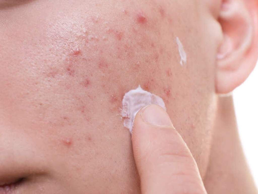 ¿Cómo identificar el acné por estrés?