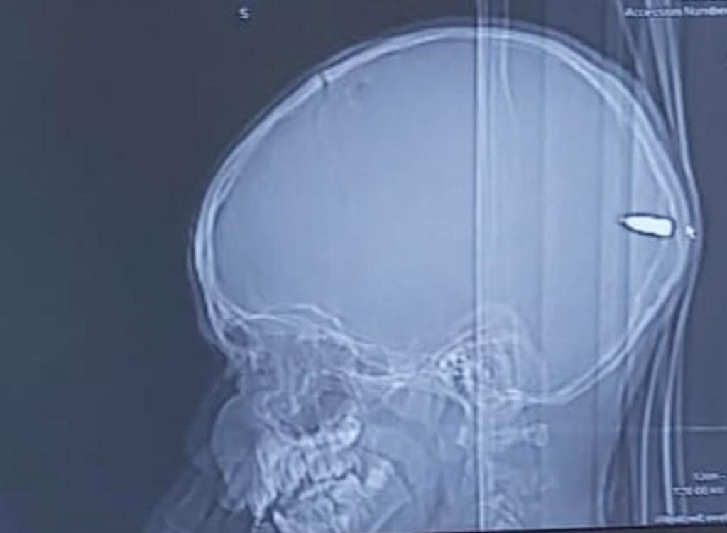 Doctores extraen una bala del cráneo de un niño de 9 años