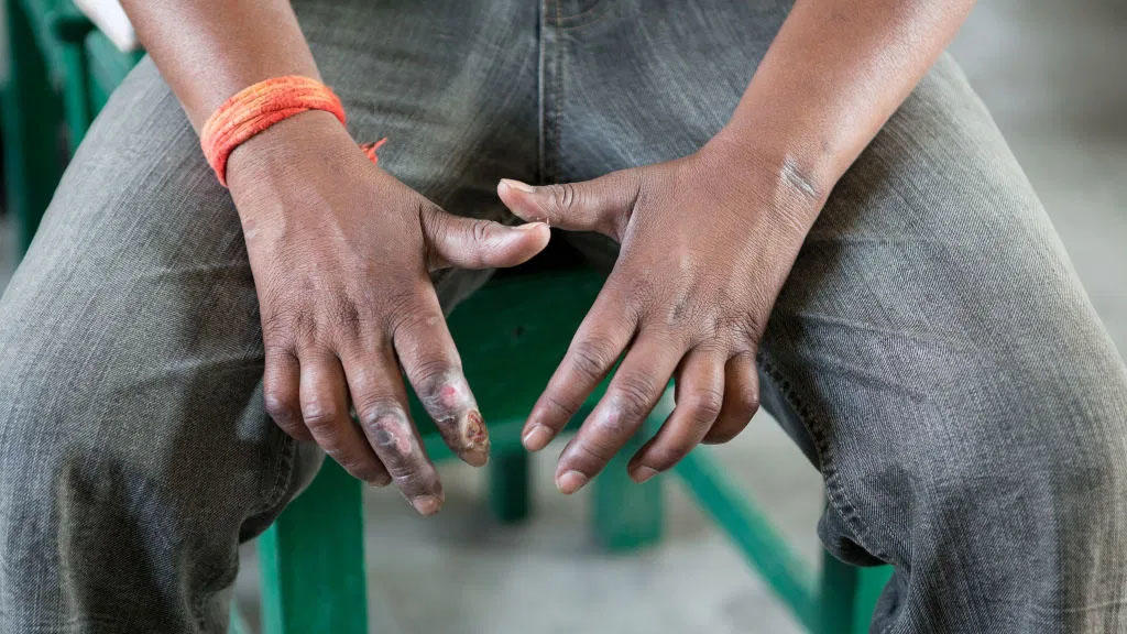 México tiene 89 casos de lepra en 18 estados