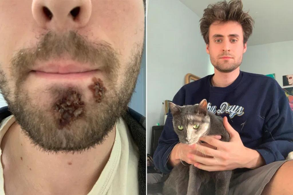 Hombre contra infección por afeitarse con la rasuradora de otra persona