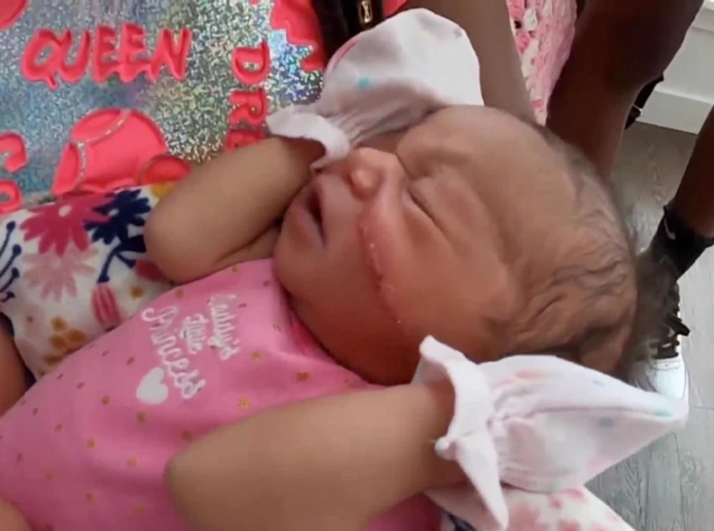 Bebé nace con un corte en la cara tras cesárea de emergencia