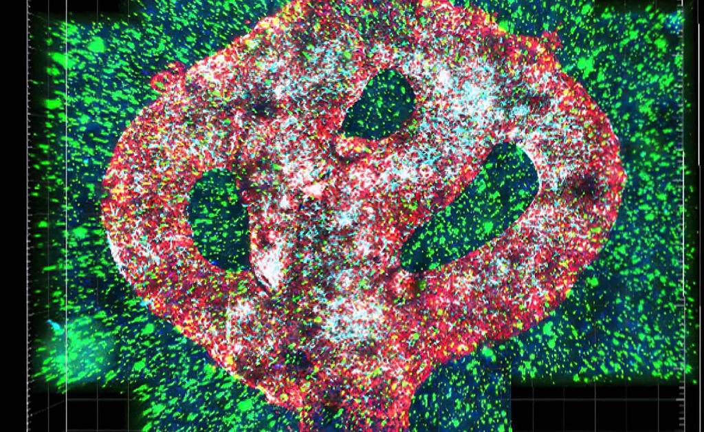 Crean tumor cerebral en 3D que ayudará a investigar tratamientos