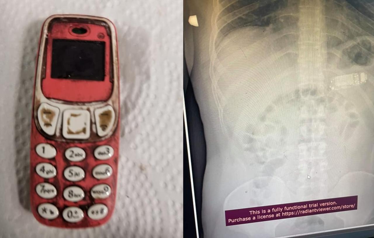 Hombre se traga un celular Nokia y médicos lo extraen sin abrirle el estómago
