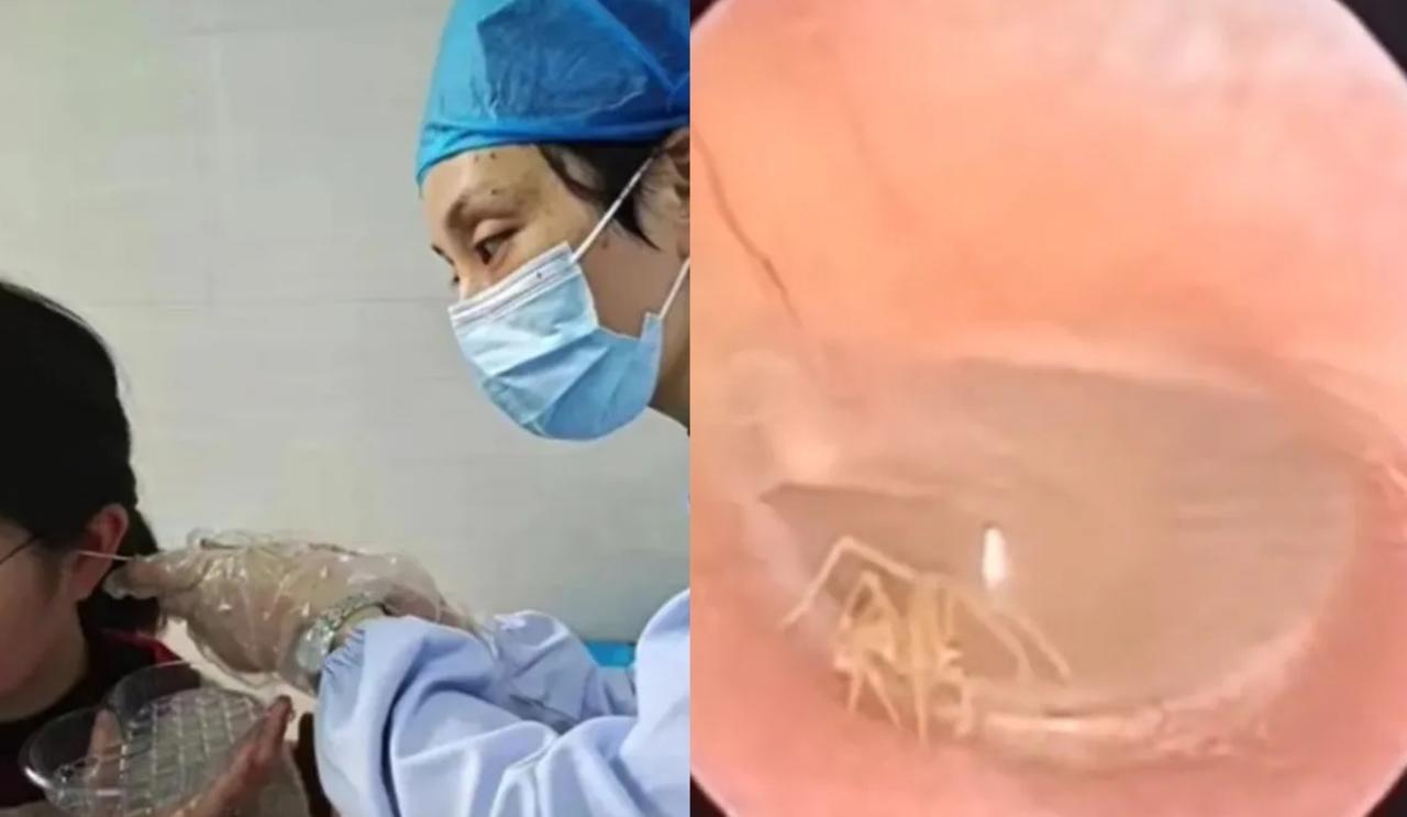 Mujer acude al médico por una 'molestia' en el oído y resulta ser una araña