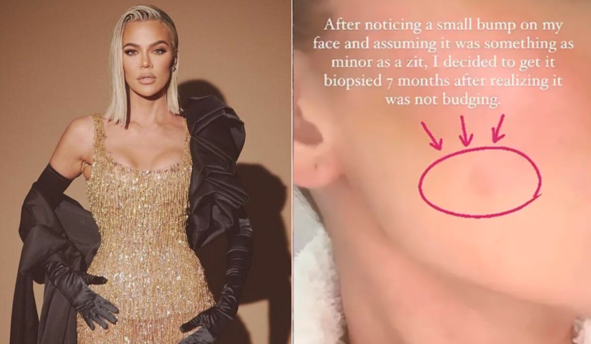 Khloe Kardashian sorprende al revelar que le extirparon un tumor de la cara