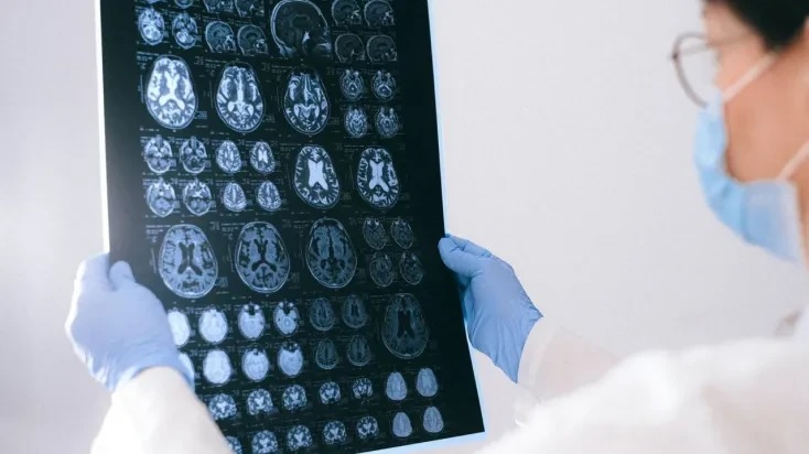 Un ensayo clínico logra reducir el tamaño de un raro tumor cerebral en un 91 %