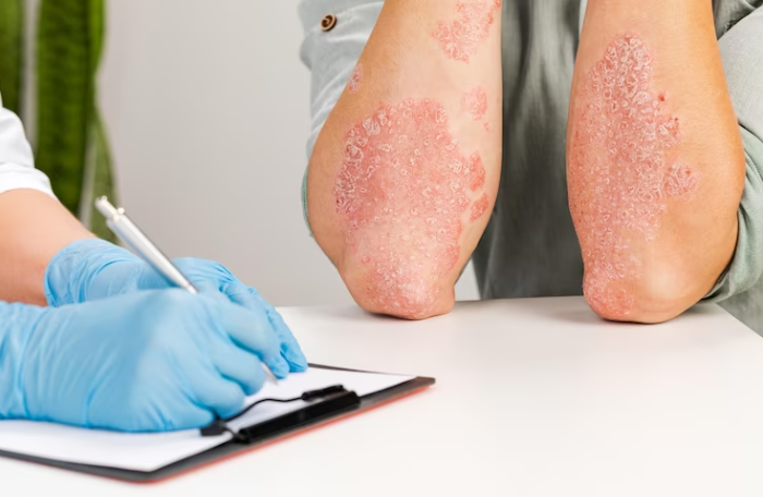 Así son los síntomas de la psoriasis