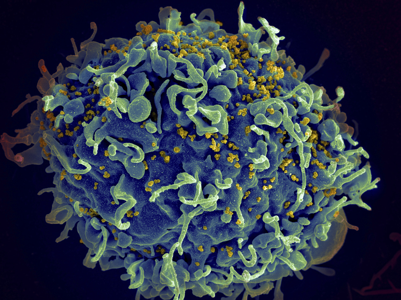 Identifican primeros casos de VIH por 'faciales vampíricos'