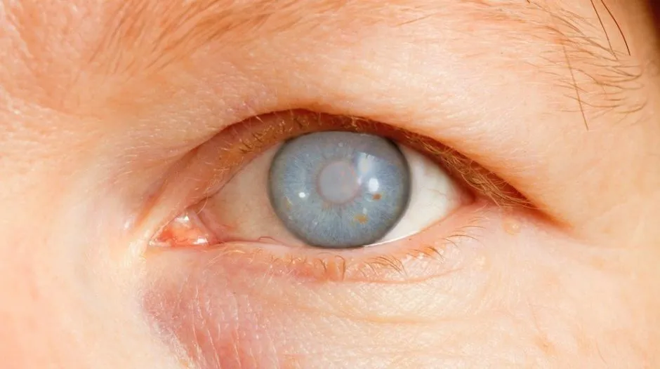 ¿Cómo detectar el glaucoma a tiempo?