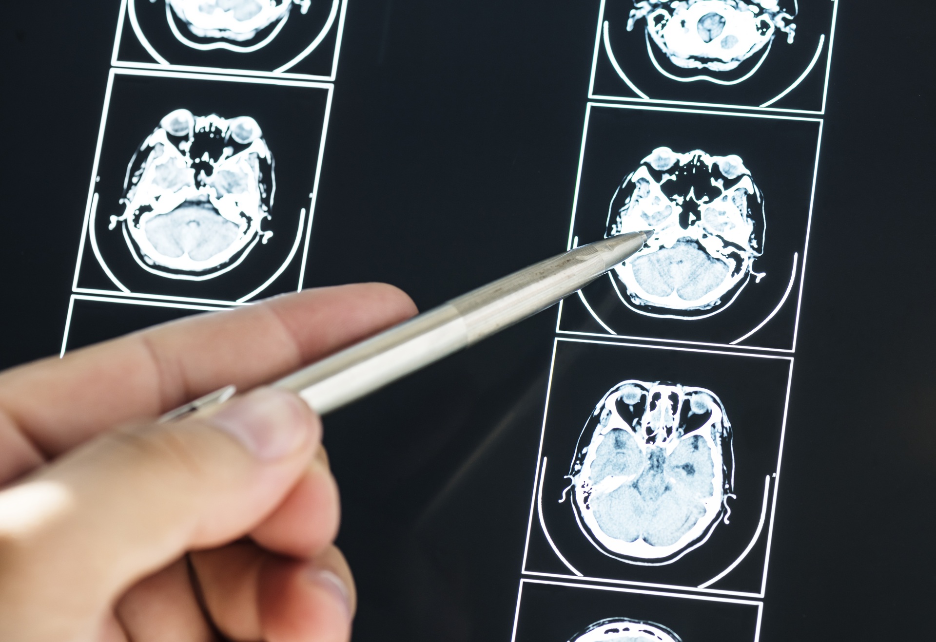 ¿Cuáles son los síntomas de un tumor cerebral?